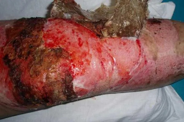 深二度烧伤不植皮能自愈吗？2025年最新修复周期与疤痕管理实战指南