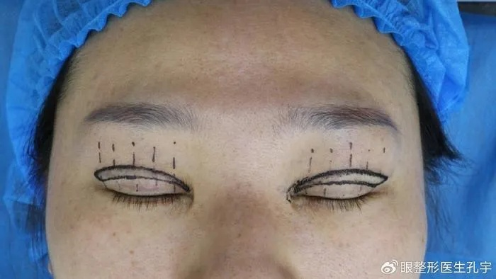 女子双眼皮修复后眼皮多个洞？2026紧急修复指南与真实案例拆解